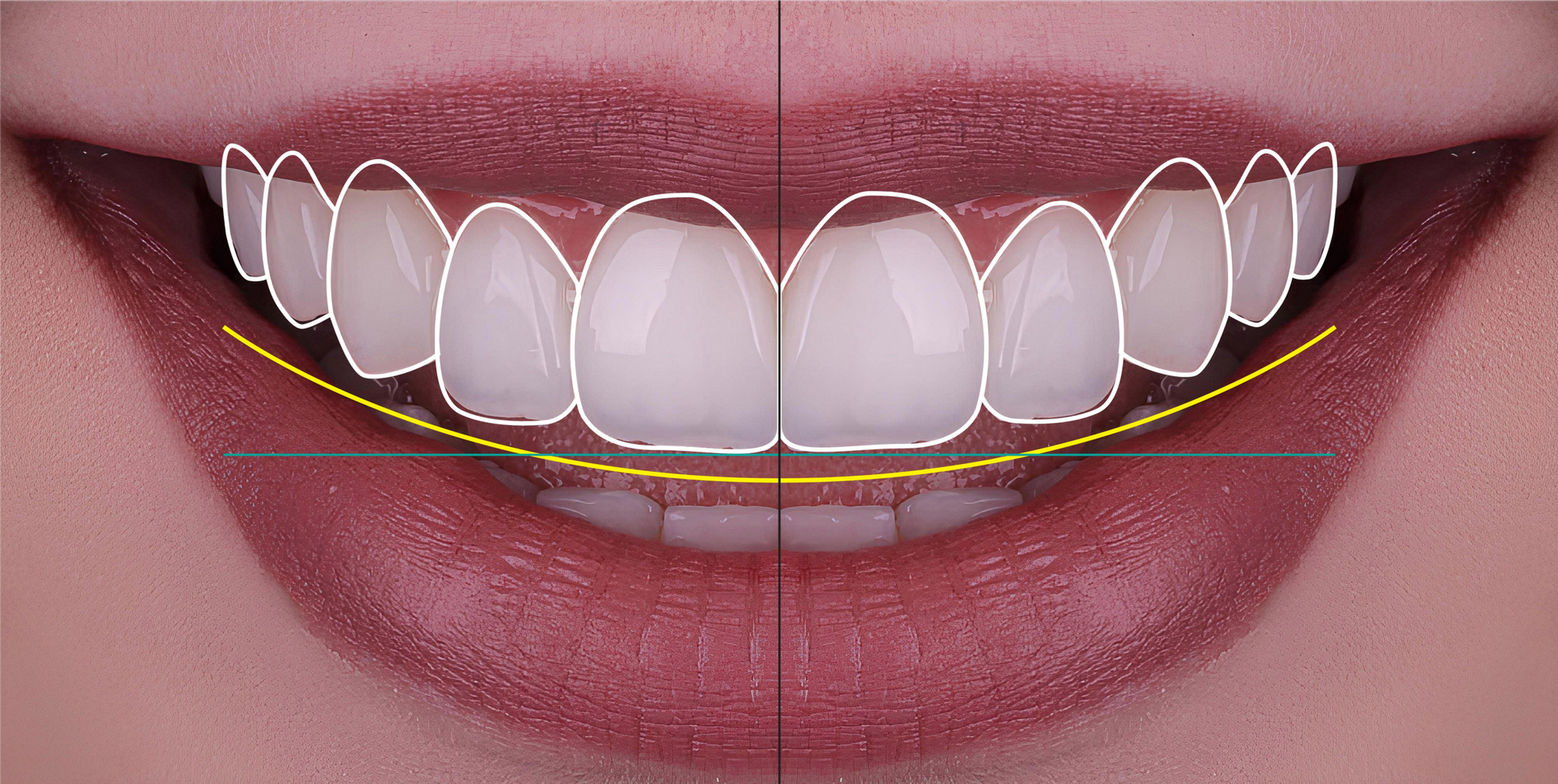 Illustration du Smile Design