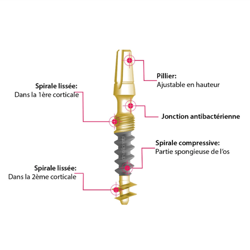 Schéma d'un implant cortico-basal