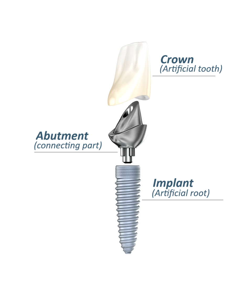 Diagram of a traditional dental implant