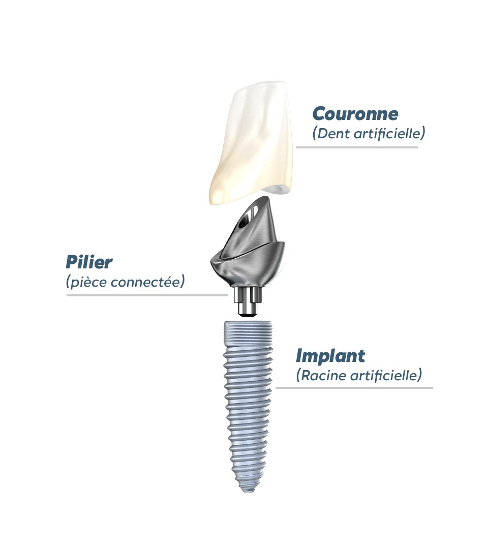 Schéma d'un implant dentaire traditionnel